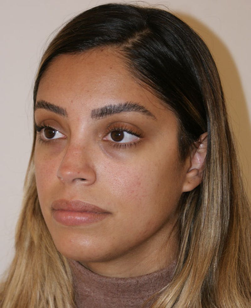 Rhinoplasty Before & After Gallery - Patient 118802 - Image 4