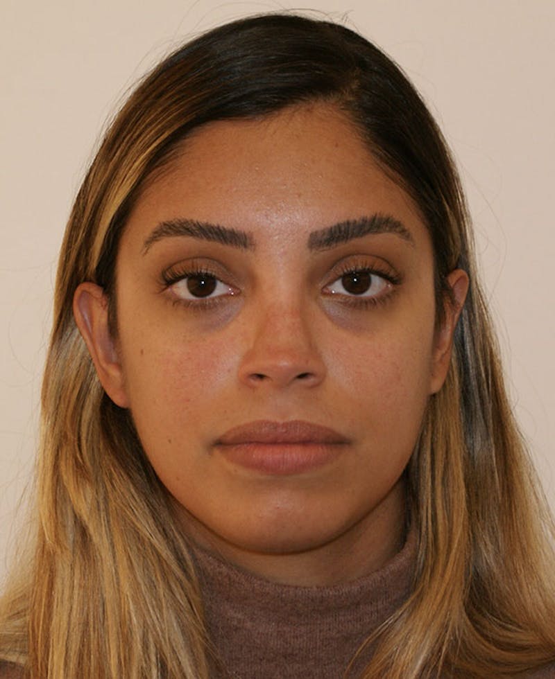 Rhinoplasty Before & After Gallery - Patient 118802 - Image 6