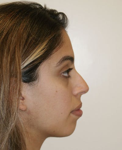 Rhinoplasty Before & After Gallery - Patient 118802 - Image 1