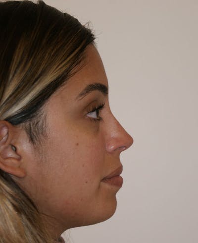 Rhinoplasty Before & After Gallery - Patient 118802 - Image 2
