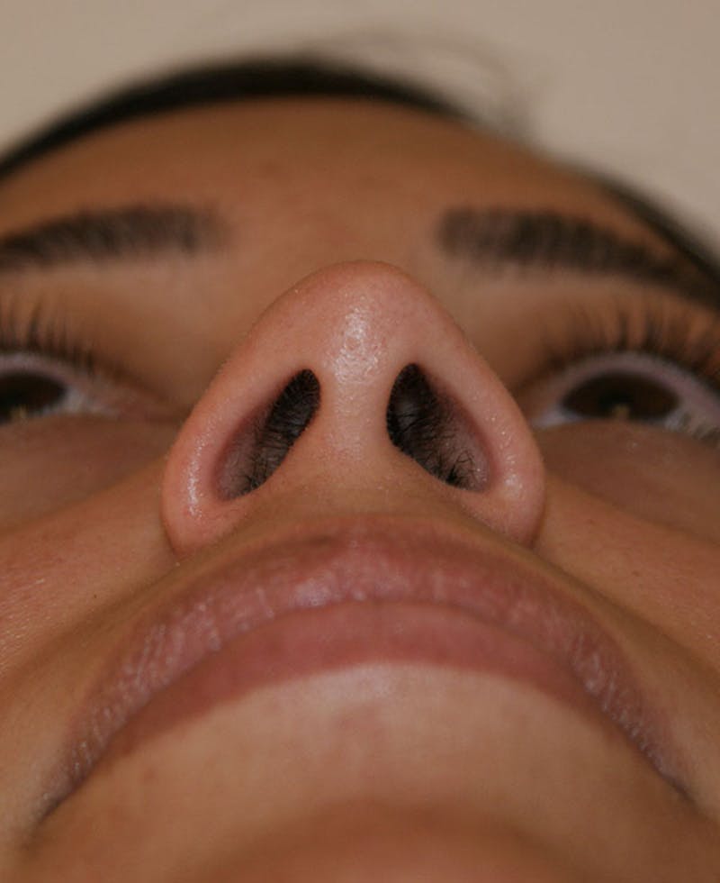 Rhinoplasty Before & After Gallery - Patient 118802 - Image 7