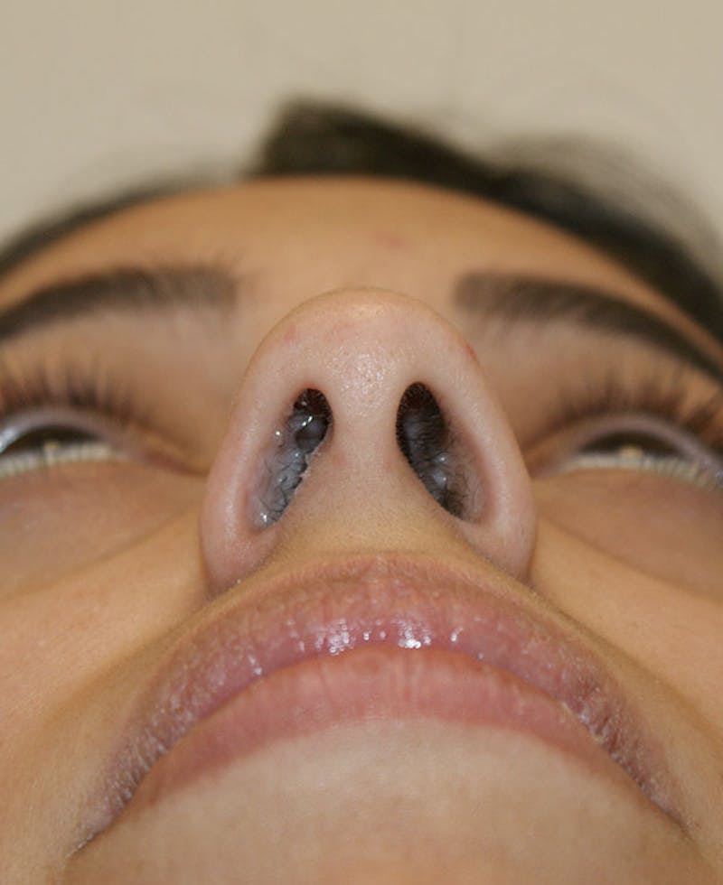 Rhinoplasty Before & After Gallery - Patient 118802 - Image 8