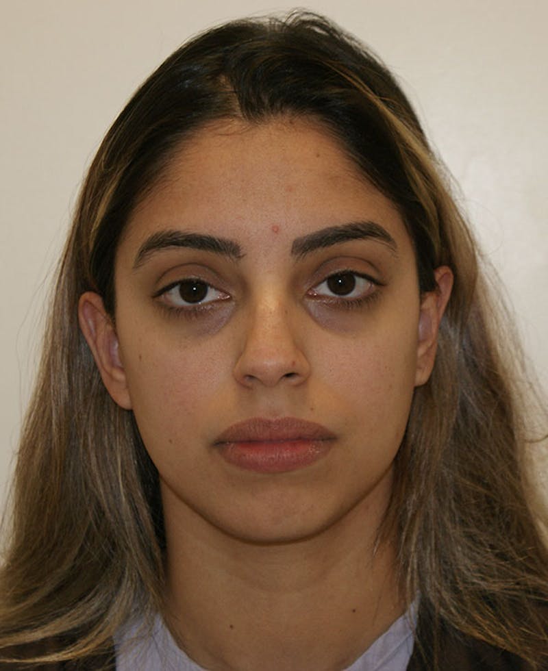 Rhinoplasty Before & After Gallery - Patient 118802 - Image 5
