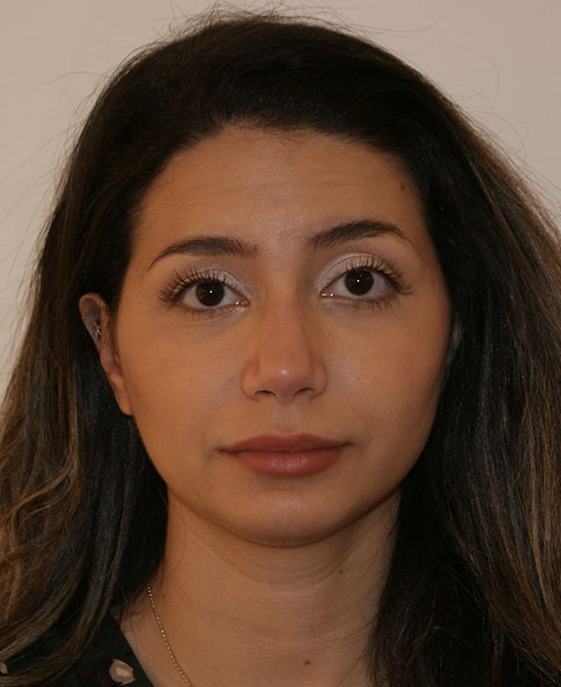 Rhinoplasty Before & After Gallery - Patient 175383 - Image 8