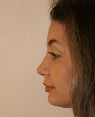 Rhinoplasty Before & After Gallery - Patient 175383 - Image 2