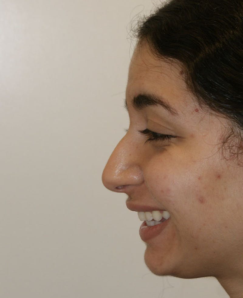 Rhinoplasty Before & After Gallery - Patient 175383 - Image 3