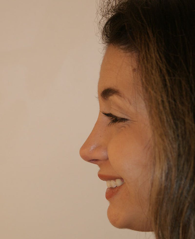 Rhinoplasty Before & After Gallery - Patient 175383 - Image 4