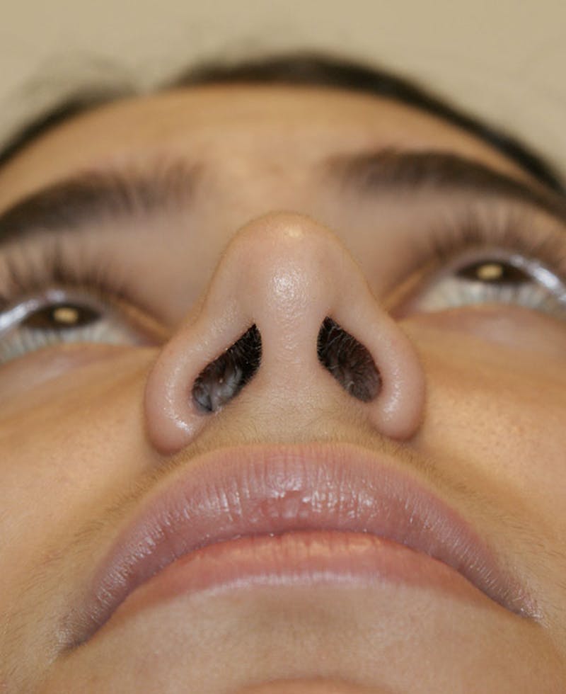Rhinoplasty Before & After Gallery - Patient 175383 - Image 9