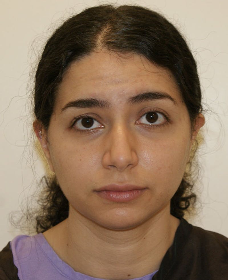 Rhinoplasty Before & After Gallery - Patient 175383 - Image 7