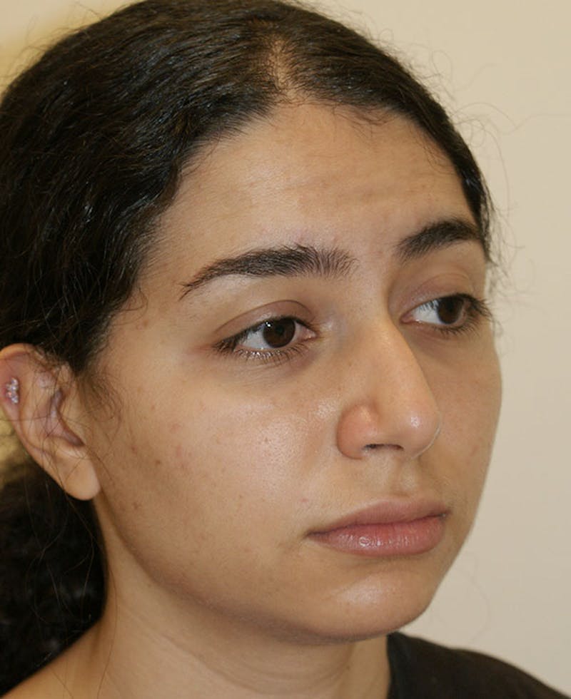 Rhinoplasty Before & After Gallery - Patient 175383 - Image 5