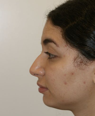 Rhinoplasty Before & After Gallery - Patient 175383 - Image 1