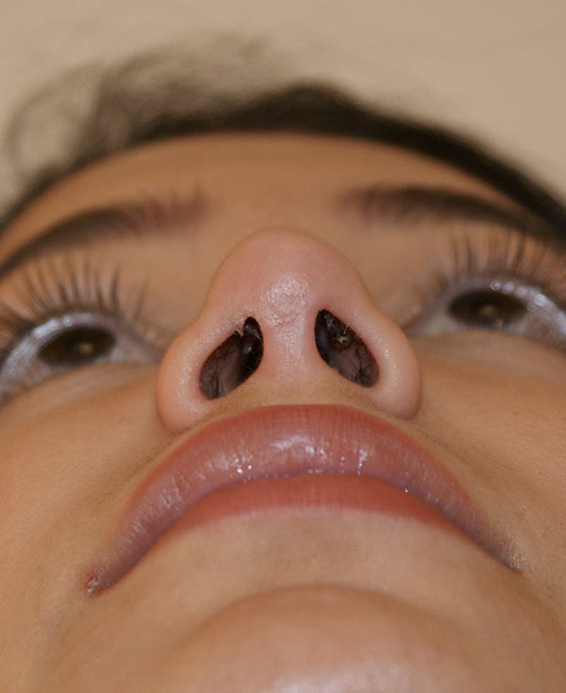 Rhinoplasty Before & After Gallery - Patient 175383 - Image 10