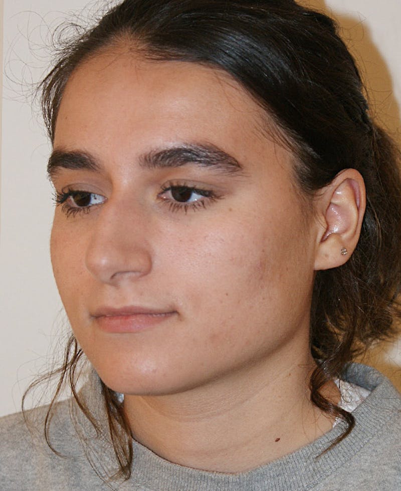 Rhinoplasty Before & After Gallery - Patient 361821 - Image 3