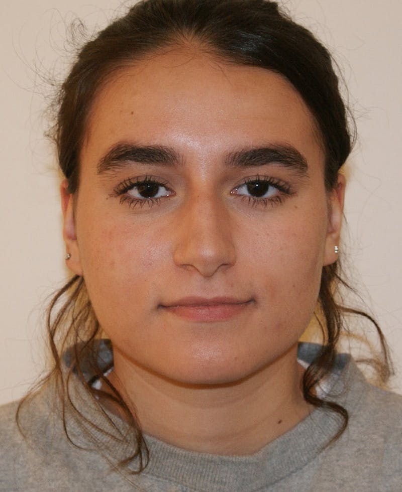 Rhinoplasty Before & After Gallery - Patient 361821 - Image 5