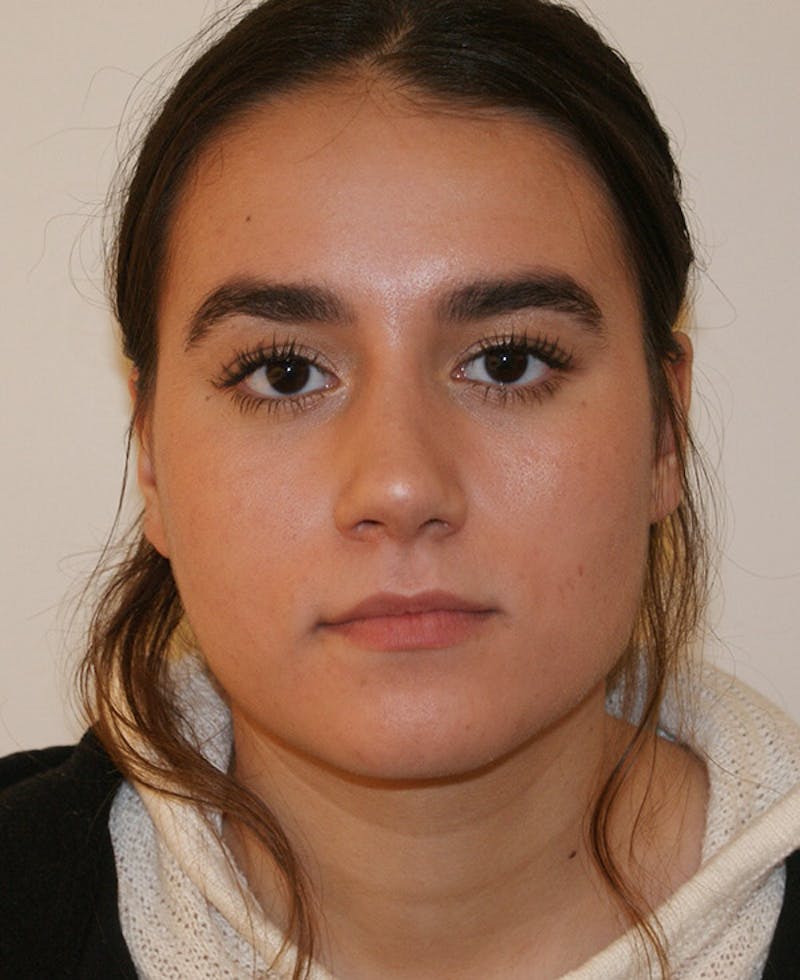 Rhinoplasty Before & After Gallery - Patient 361821 - Image 6