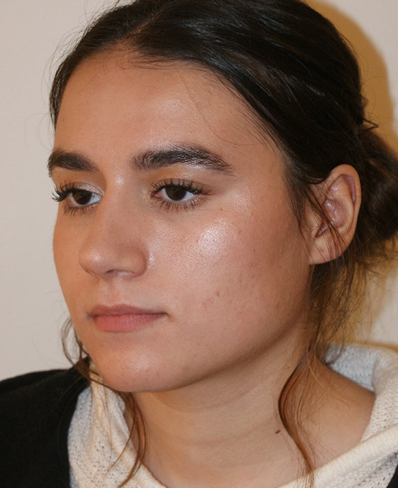 Rhinoplasty Before & After Gallery - Patient 361821 - Image 4