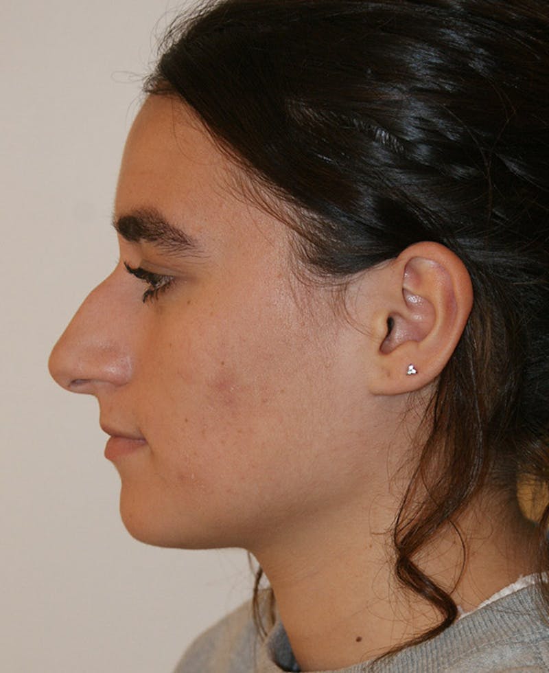 Rhinoplasty Before & After Gallery - Patient 361821 - Image 1