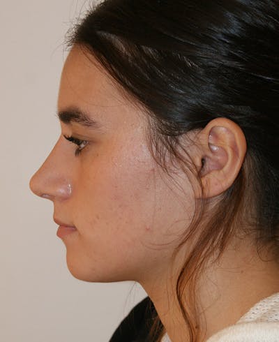 Rhinoplasty Before & After Gallery - Patient 361821 - Image 2