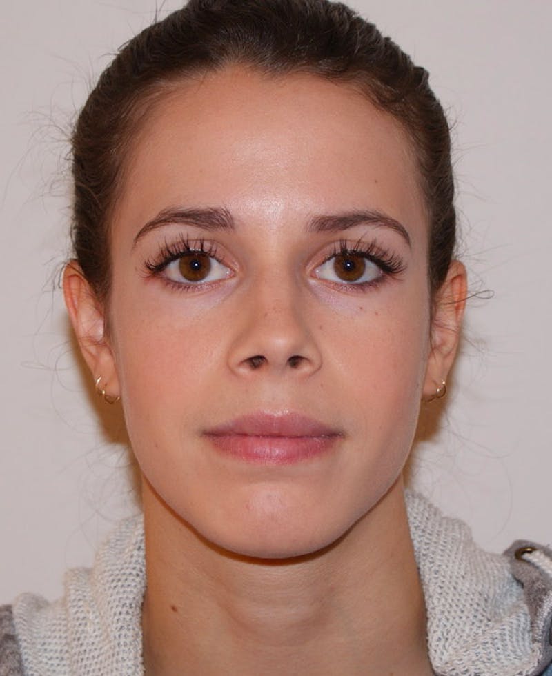 Rhinoplasty Before & After Gallery - Patient 397739 - Image 6