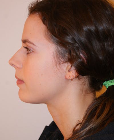 Rhinoplasty Before & After Gallery - Patient 397739 - Image 1