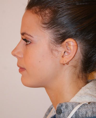 Rhinoplasty Before & After Gallery - Patient 397739 - Image 2
