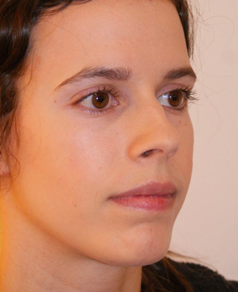 Rhinoplasty Before & After Gallery - Patient 397739 - Image 3