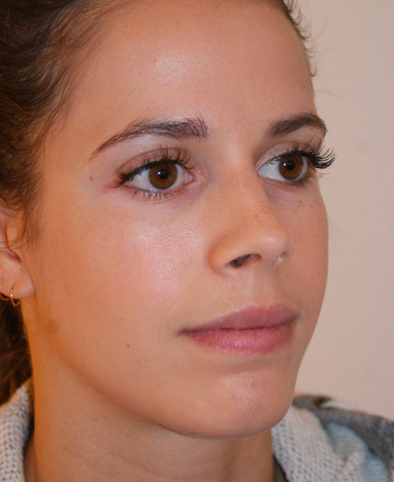 Rhinoplasty Before & After Gallery - Patient 397739 - Image 4