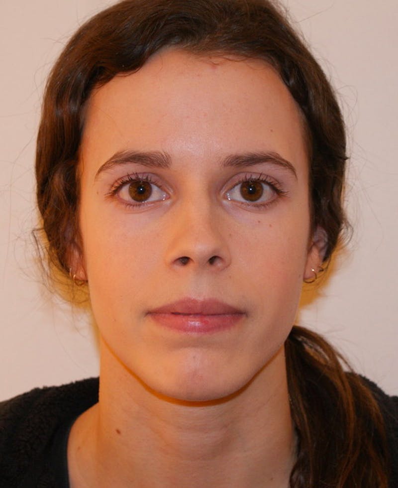 Rhinoplasty Before & After Gallery - Patient 397739 - Image 5