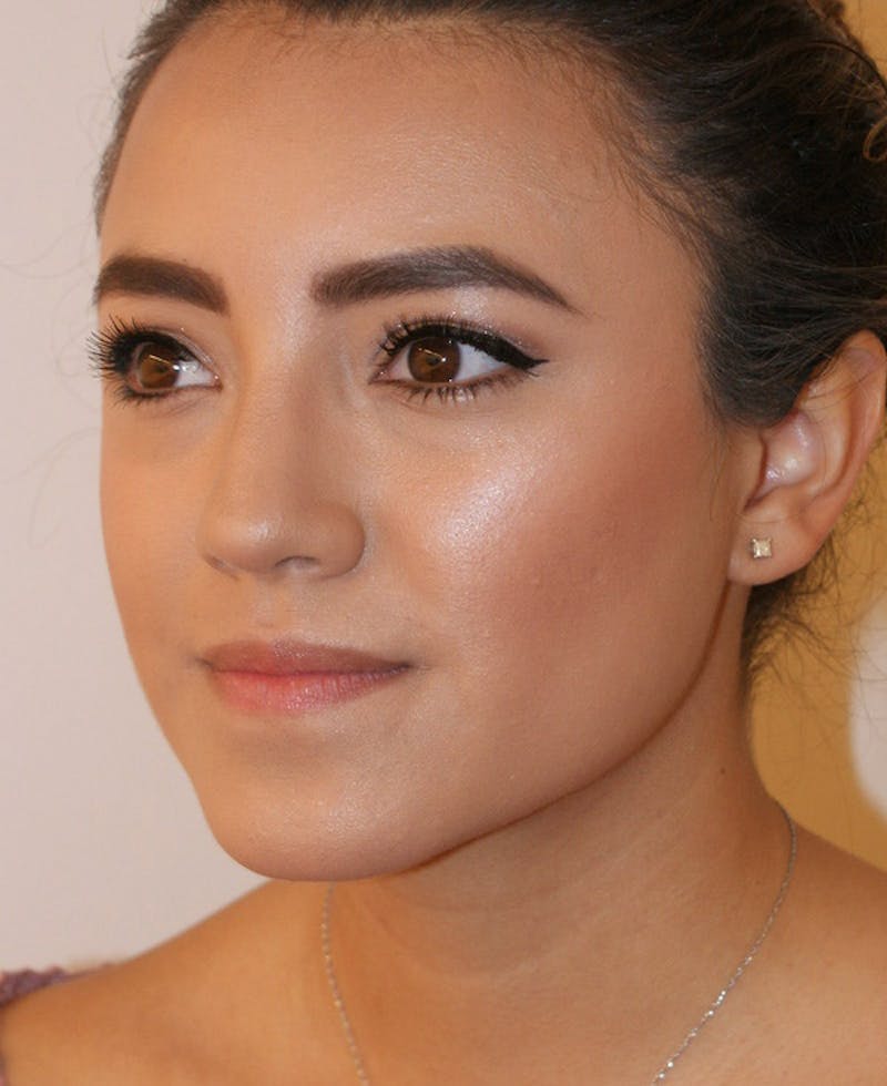 Rhinoplasty Before & After Gallery - Patient 227267 - Image 4