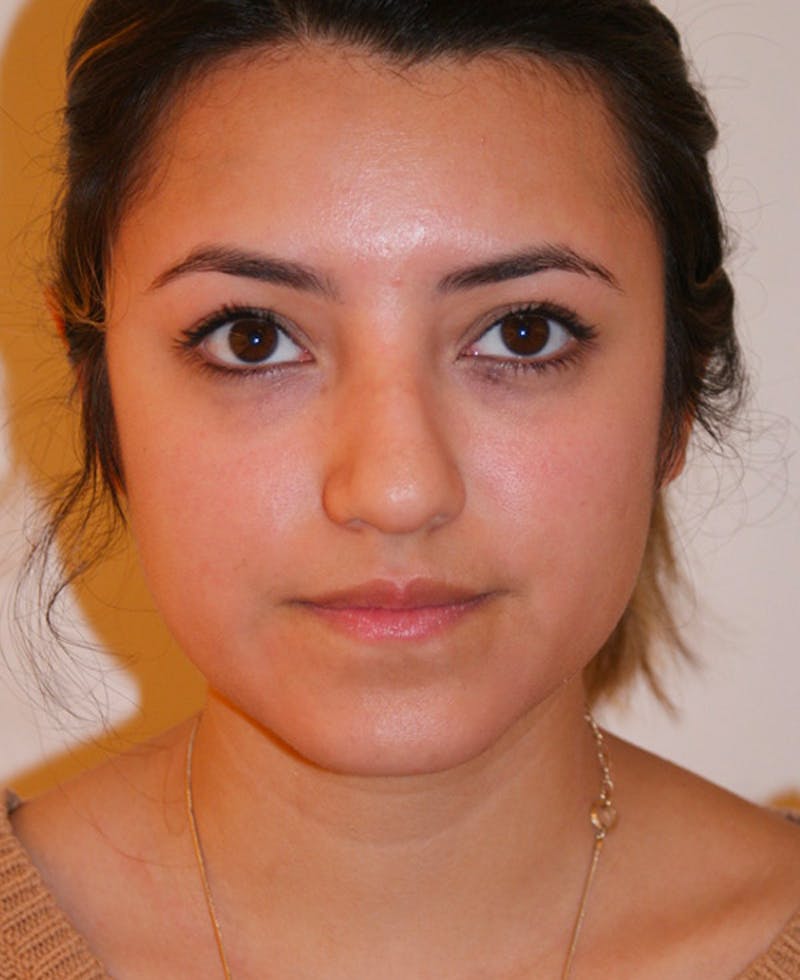 Rhinoplasty Before & After Gallery - Patient 227267 - Image 5
