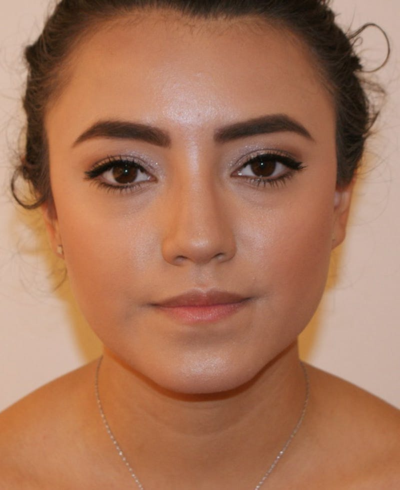 Rhinoplasty Before & After Gallery - Patient 227267 - Image 6