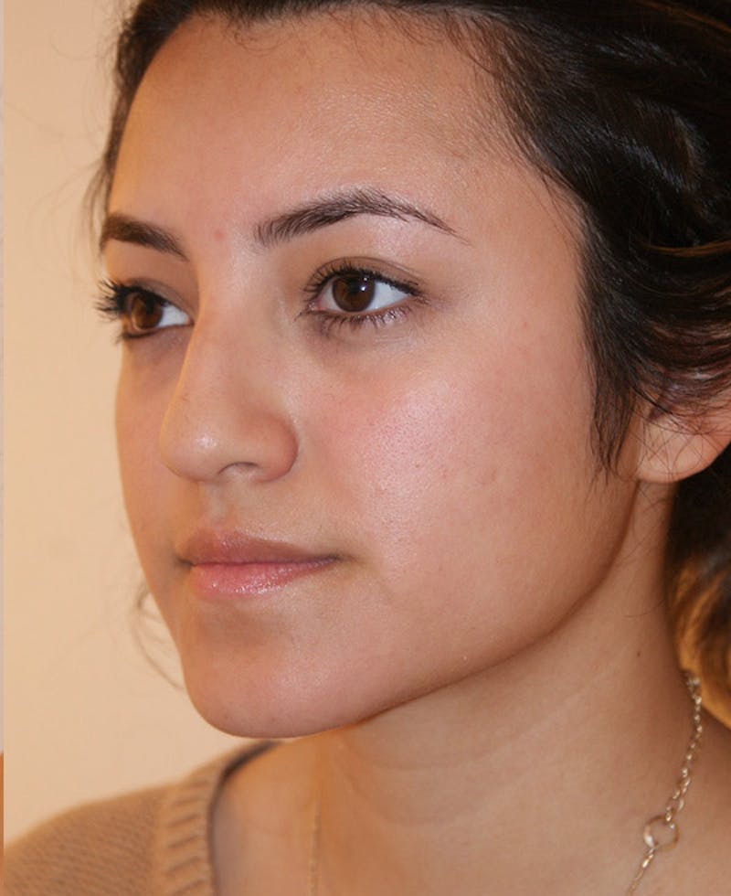Rhinoplasty Before & After Gallery - Patient 227267 - Image 3