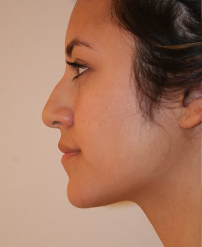 Rhinoplasty Before & After Gallery - Patient 227267 - Image 1