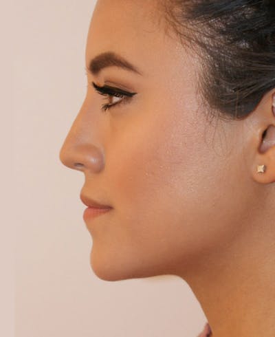Rhinoplasty Before & After Gallery - Patient 227267 - Image 2