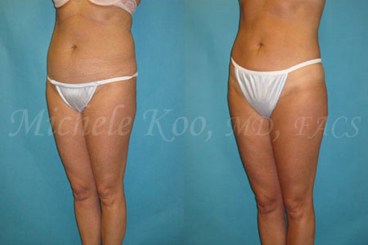 Tummy Tuck (Abdominoplasty) Before & After Gallery - Patient 276390 - Image 1