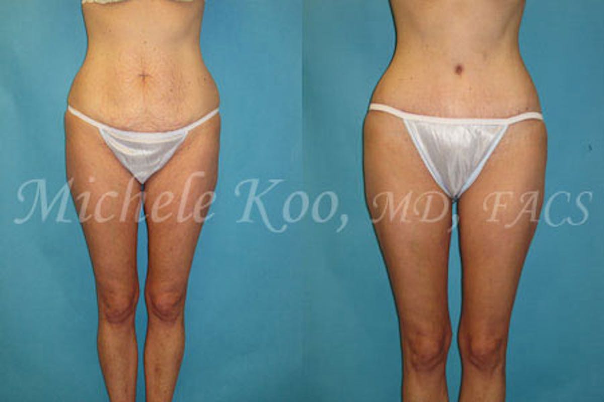 Tummy Tuck (Abdominoplasty) Before & After Gallery - Patient 838644 - Image 1