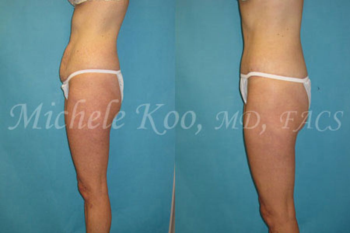 Tummy Tuck (Abdominoplasty) Before & After Gallery - Patient 838644 - Image 3