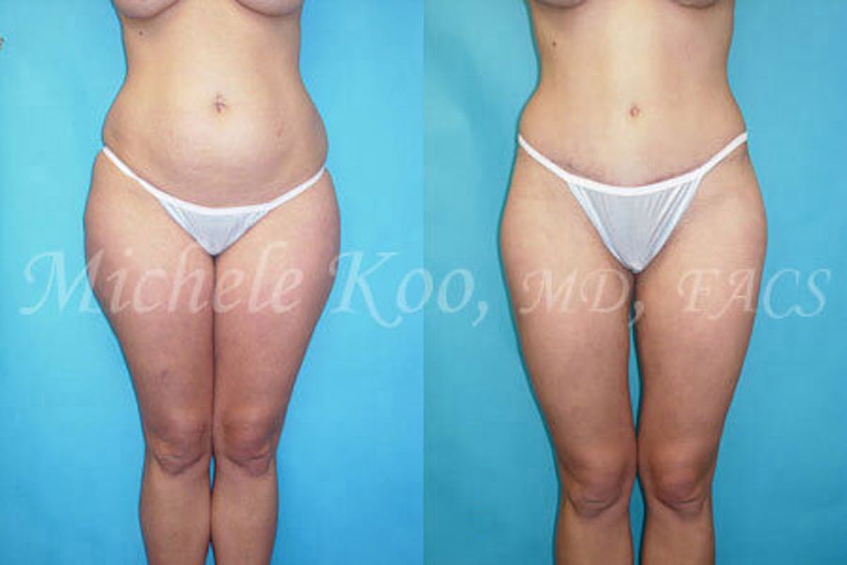 Tummy Tuck (Abdominoplasty) Before & After Gallery - Patient 802562 - Image 1