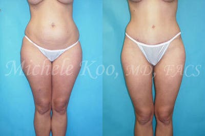 Tummy Tuck (Abdominoplasty) Before & After Gallery - Patient 802562 - Image 1