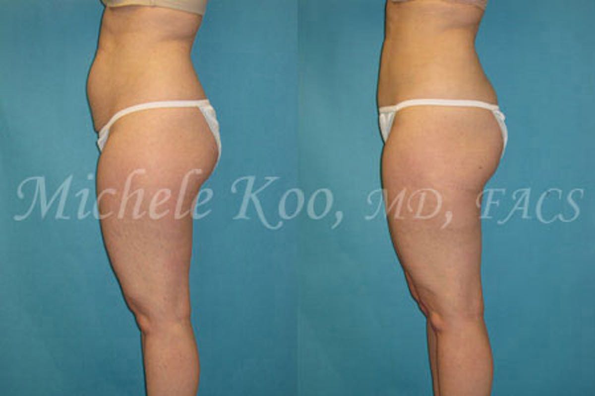 Tummy Tuck (Abdominoplasty) Before & After Gallery - Patient 802562 - Image 4