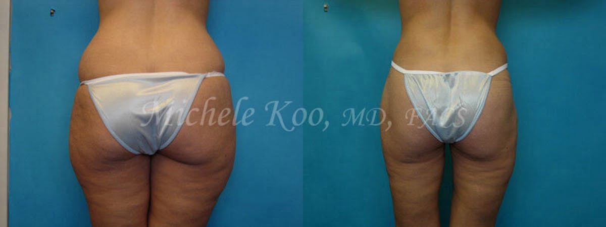 Tummy Tuck (Abdominoplasty) Before & After Gallery - Patient 802562 - Image 3