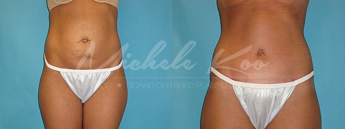 Tummy Tuck (Abdominoplasty) Before & After Gallery - Patient 803956 - Image 1