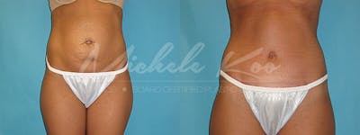Tummy Tuck (Abdominoplasty) Before & After Gallery - Patient 803956 - Image 1