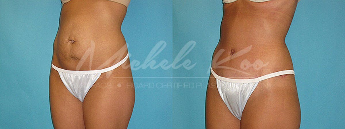 Tummy Tuck (Abdominoplasty) Before & After Gallery - Patient 803956 - Image 2