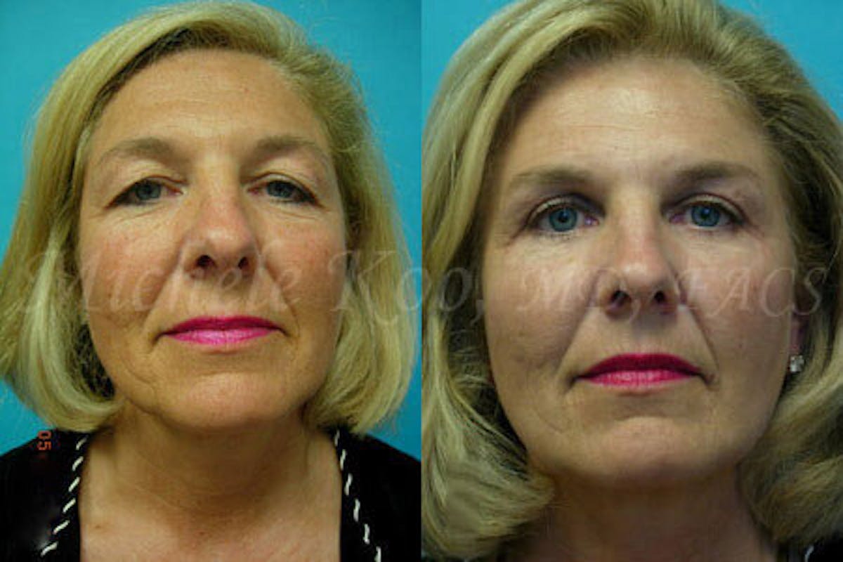 Eyelid Surgery (Blepharoplasty) Before & After Gallery - Patient 149559 - Image 4