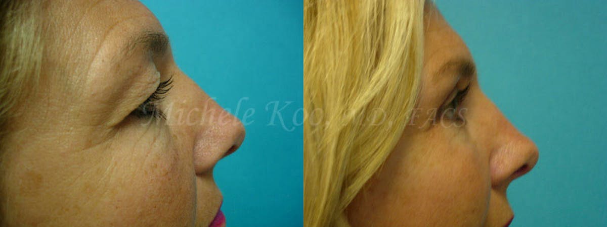 Eyelid Surgery (Blepharoplasty) Before & After Gallery - Patient 149559 - Image 3