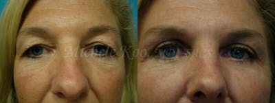 Eyelid Surgery (Blepharoplasty) Before & After Gallery - Patient 149559 - Image 1