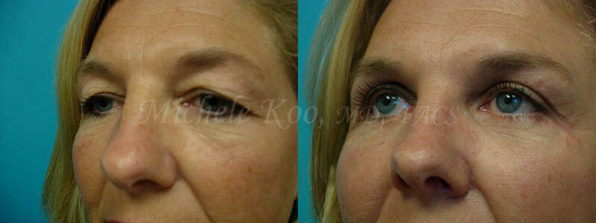 Eyelid Surgery (Blepharoplasty) Before & After Gallery - Patient 149559 - Image 2