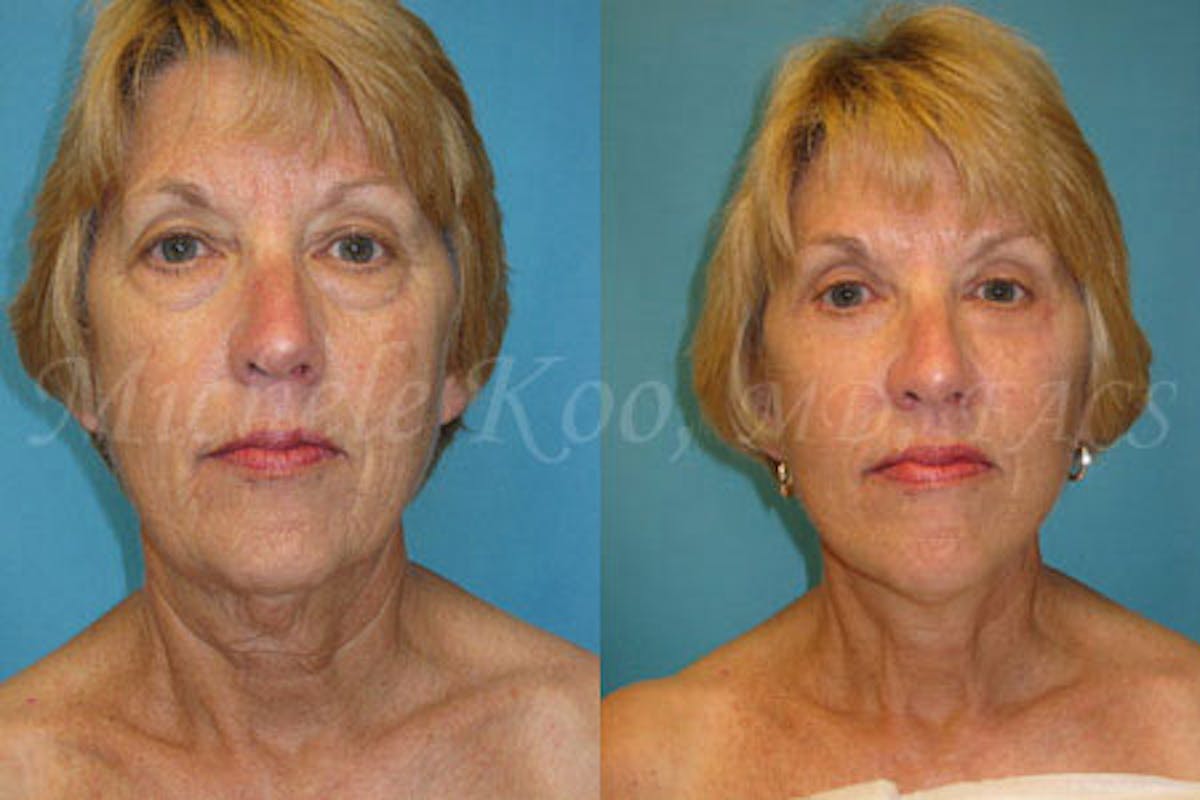 Eyelid Surgery (Blepharoplasty) Before & After Gallery - Patient 307287 - Image 2