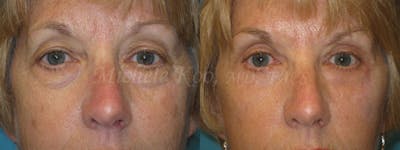 Eyelid Surgery (Blepharoplasty) Before & After Gallery - Patient 307287 - Image 1